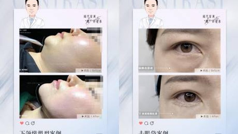 隆鼻后戴眼镜，影响恢复吗？揭秘术后护理细节**