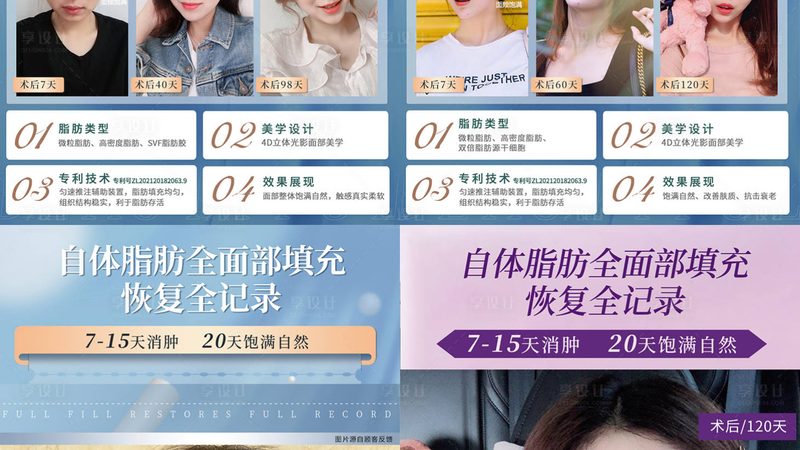 成都超声炮术后恢复期揭秘：了解真实情况