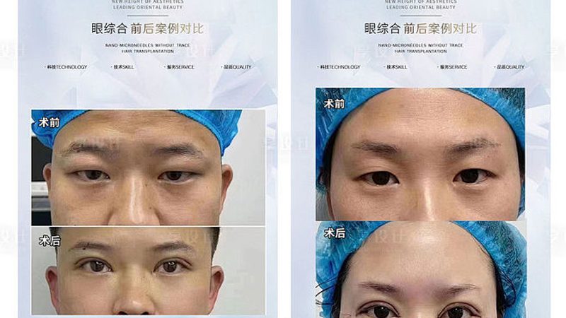 小标题：光子嫩肤的原理