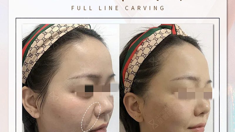 光子嫩肤后反黑？揭秘修复方法与预防技巧**