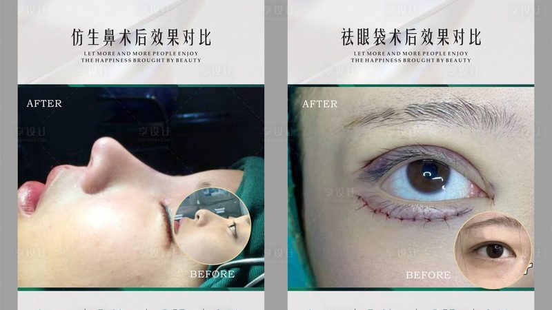 肉毒素副作用消失需要多久？答案比你想的简单