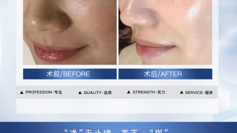 热玛吉：面部与身体作用的差异解析