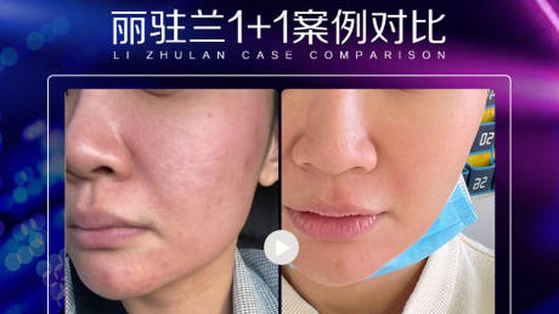 轻医美VS传统医美：揭秘恢复期短的秘密