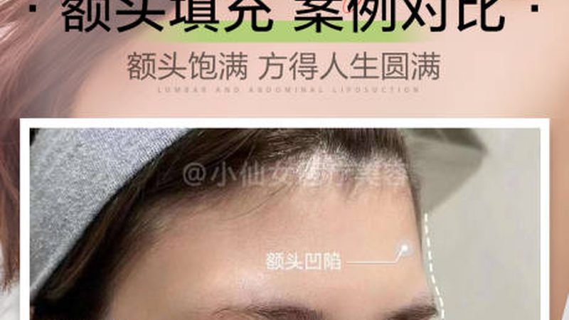 成都割双眼皮恢复期揭秘：了解这些，恢复无忧